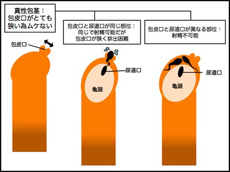 ほうけい 種類|【泌尿器科の専門医が徹底解説】包茎の全4種類とそ。